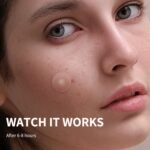 Pimple Patches for Face, 4 Size 300 Counts Acne Patches, Hydrocolloid Patches for Covering Zits and Blemishes, Spot Stickers with Salicylic Acid, Tea Tree Oil & Calendula Oil - Image 4